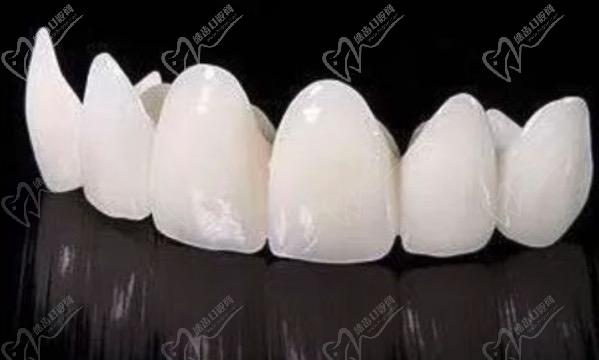 請問牙齒貼面跟全瓷冠的區(qū)別有哪些？
