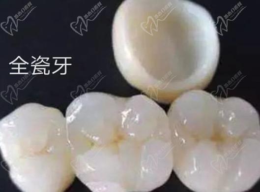 請問牙齒貼面跟全瓷冠的區(qū)別有哪些？