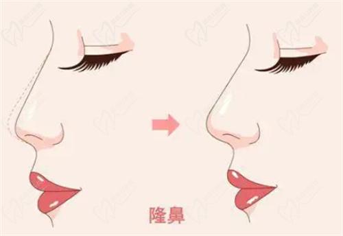 毛運(yùn)春醫(yī)生做鼻子怎么樣？